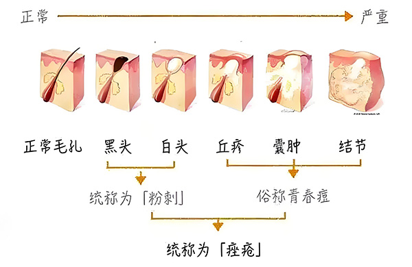 認(rèn)識黑頭 黑頭怎么去除最有效?去除黑頭最有效的方法